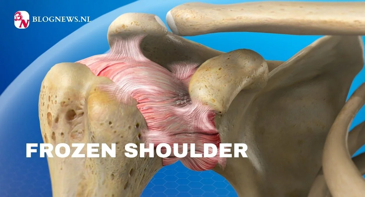 frozen shoulder