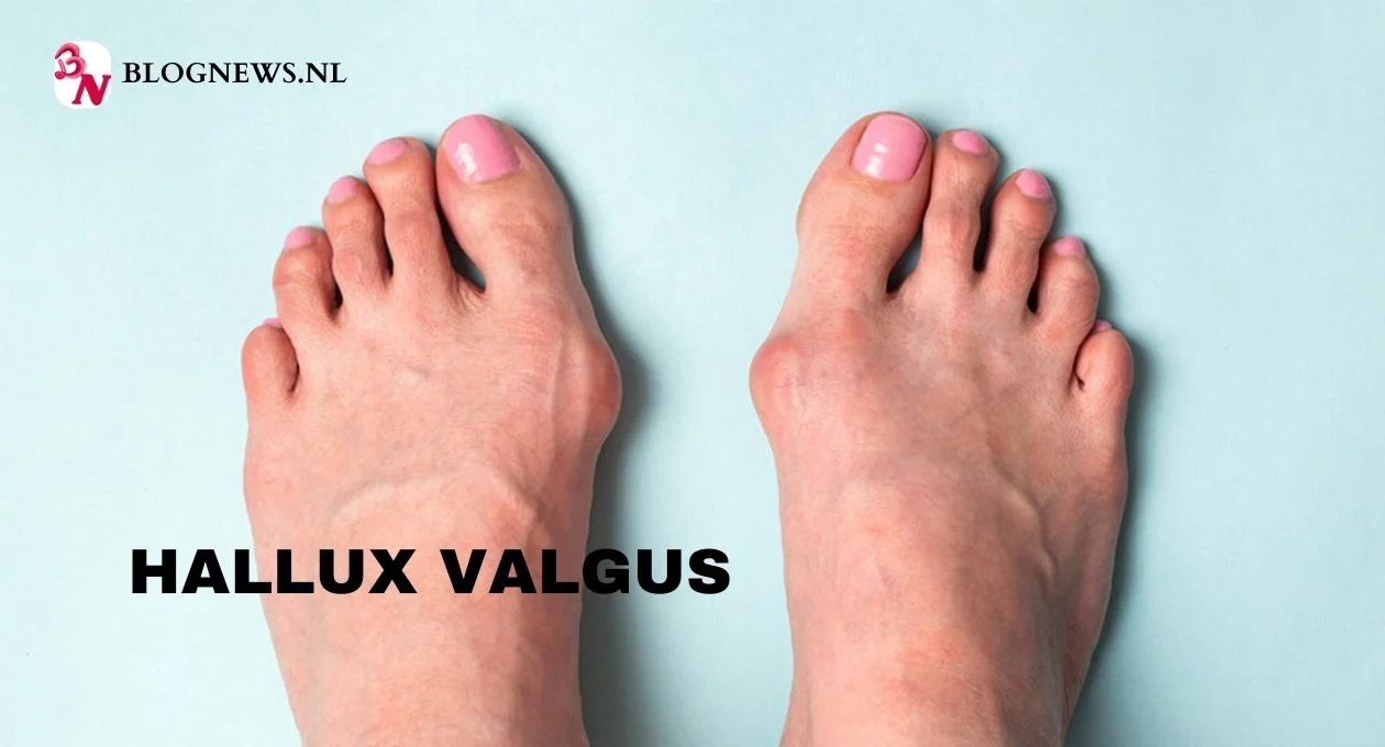 hallux valgus