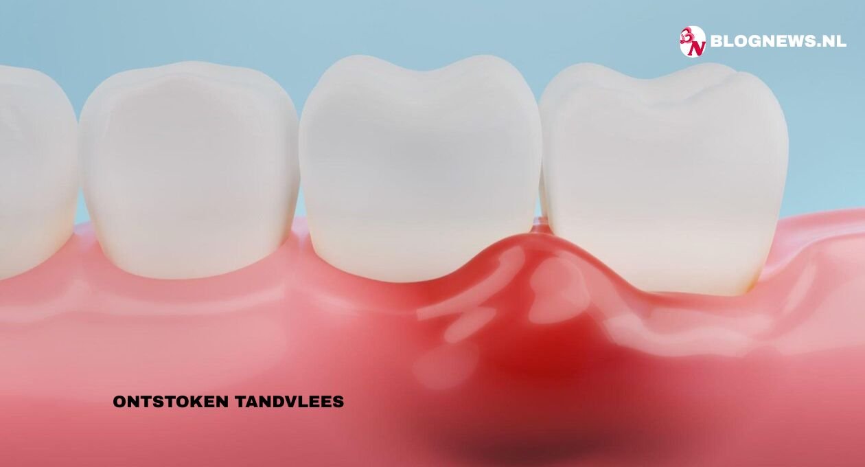 ontstoken tandvlees 